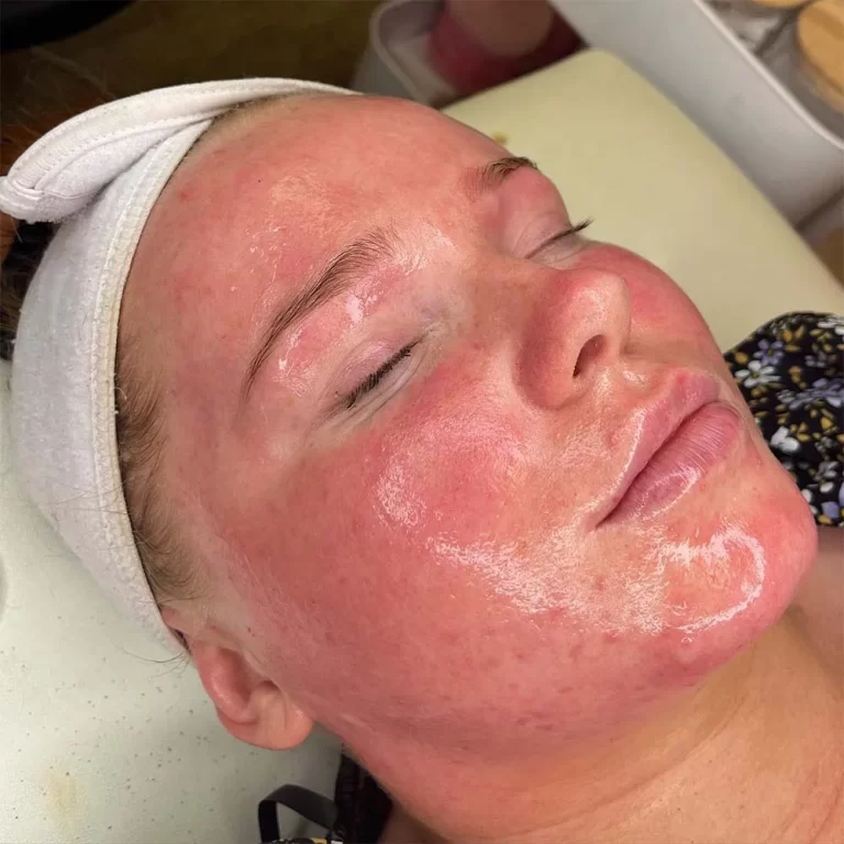 Understanding Skin Discoloration After a Chemical Peel: Causes, Prevention, and Treatment